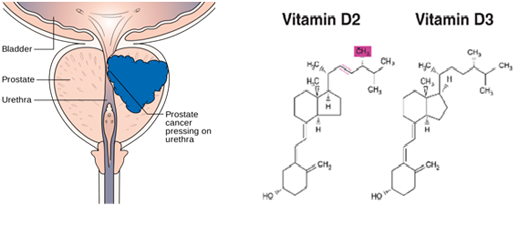 Aggressive prostate cancer can be caused by vitamin D deficiency…..