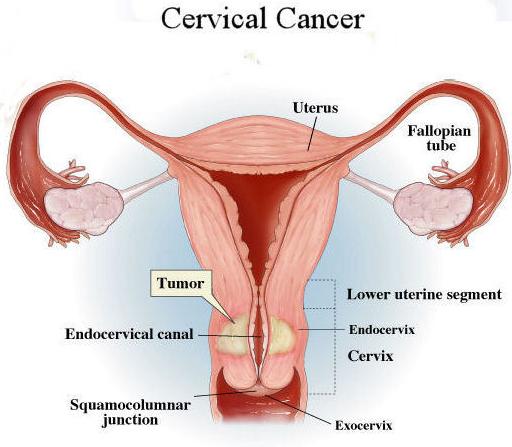Screening And Early Detection Of Cervical Cancer