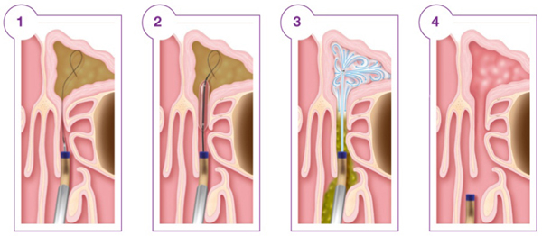 Balloon Sinuplasty – An escape from chronic Sinus problems