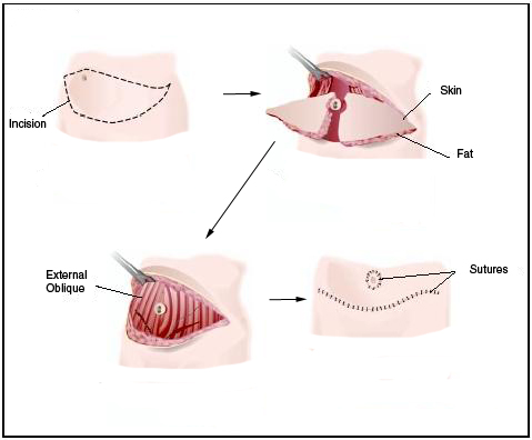 Abdominoplasty or Tummy Tuck