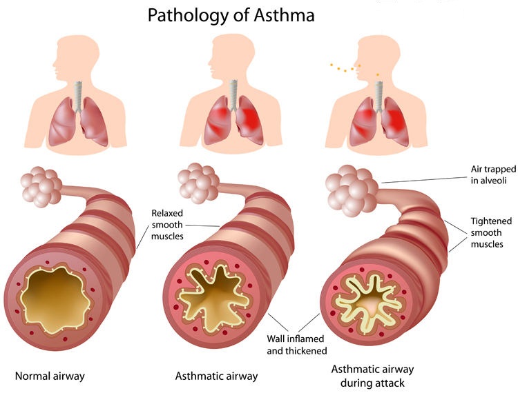 Asthma