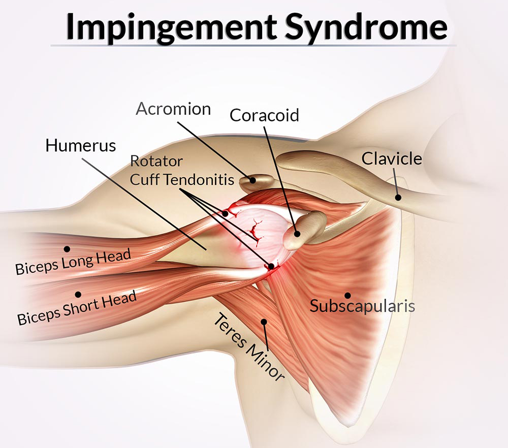 impingement-syndrome