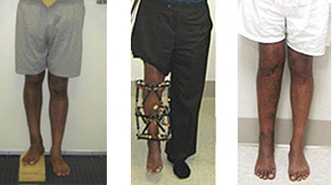 Limb Lengthening