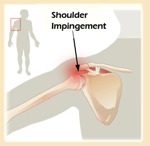 Impingement Syndrome