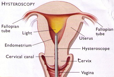 hysteroscope