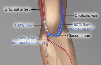 dialysis-access-management-the-miller-procedure-for-steal-syndrome