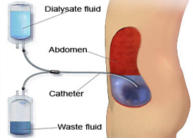 -peritoneal-dialysis-catheter