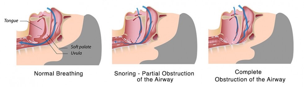 Preventing Snoring and Sleep Apnea