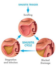 Preventing Sinus Infections