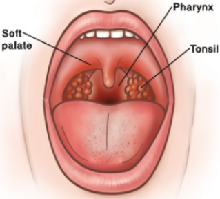 Preventing Sore Throat
