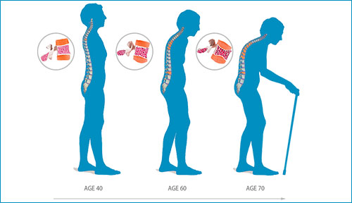 Osteoporosis: Causes, Symptoms & Prevention