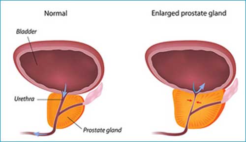 Diseases of the Prostate Gland