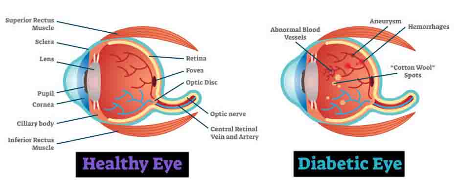 Diabetic Retinopathy