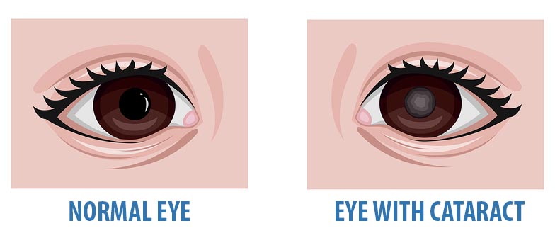 Congenital cataract