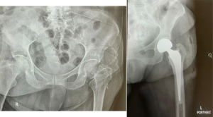 hip arthroplasty in dubai